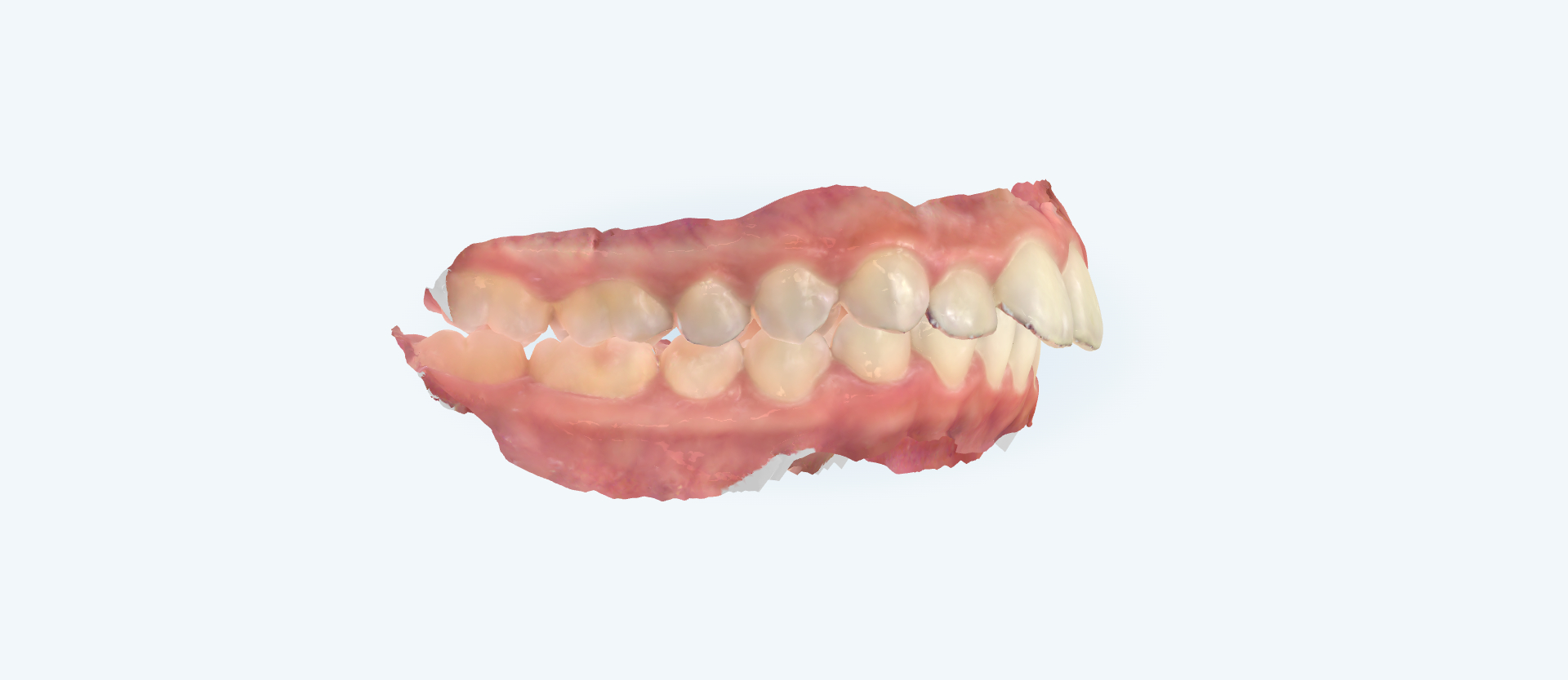 Overbite treatment comparison case 2 before